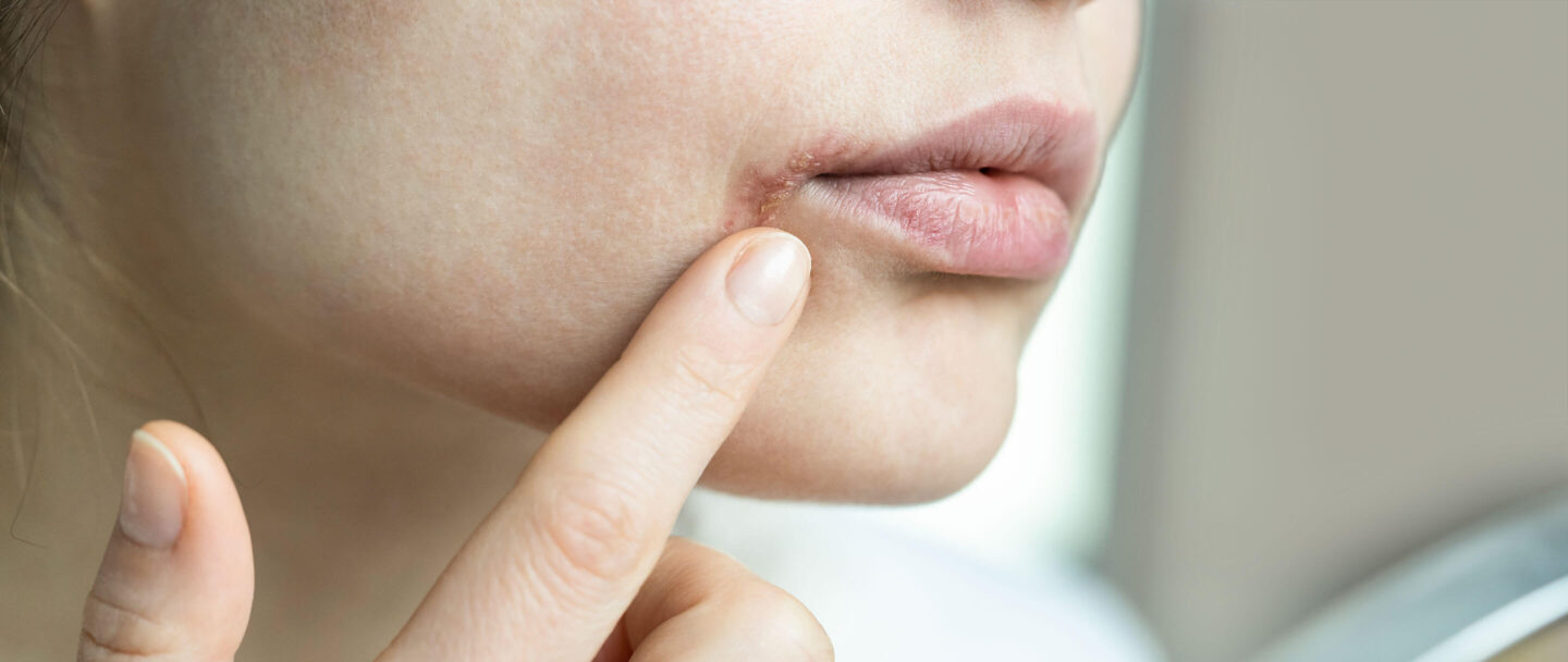 Eisenmangel Symptome und Folgen Mundwinkelrhagaden