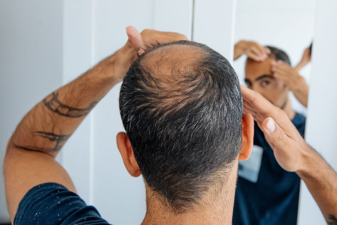 Eisenmangel Folgen, Symptom Haarausfall